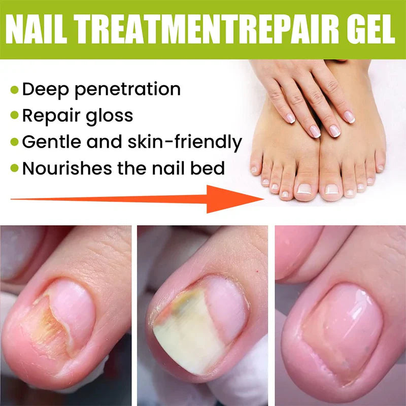 EELHOE – Nail Treatment Repair Gel